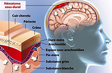 L’HEMATOME SOUS-DURAL